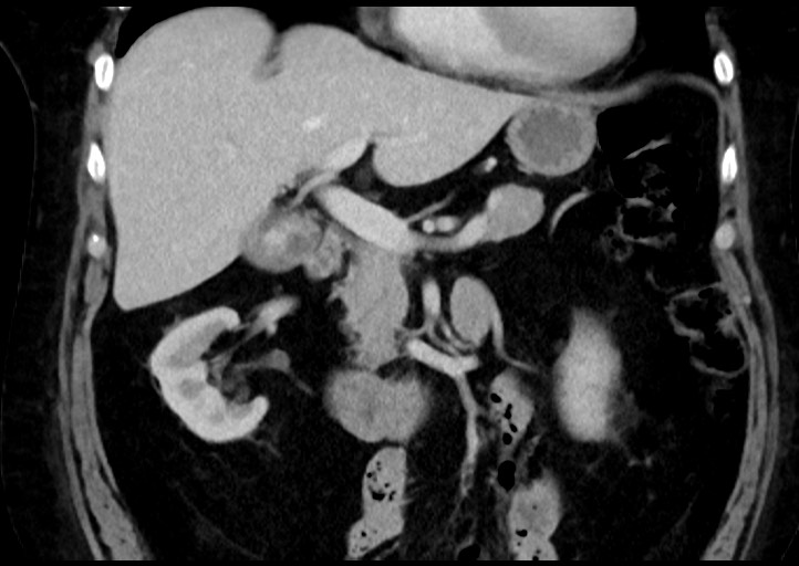 Adrenal cortical carcinoma (Radiopaedia 64017-72769 Coronal C+ portal venous phase 22).jpg