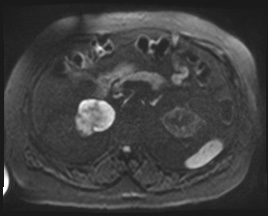 File:Adrenal cortical carcinoma (Radiopaedia 64017-72770 Axial DWI 104).jpg
