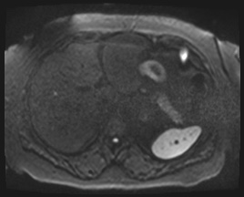 Adrenal cortical carcinoma (Radiopaedia 64017-72770 Axial DWI 94).jpg