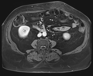 Adrenal cortical carcinoma (Radiopaedia 64017-72770 K 59).jpg