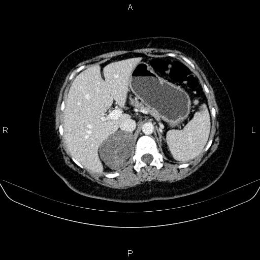 Adrenal cortical carcinoma (Radiopaedia 84882-100379 Axial C+ portal venous phase 23).jpg