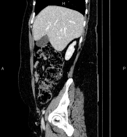 Adrenal cortical carcinoma (Radiopaedia 84882-100379 Sagittal C+ portal venous phase 21).jpg