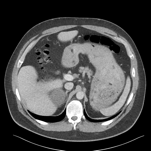 File:Adrenal cyst (Radiopaedia 45625-49777 Axial C+ portal venous phase 31).png