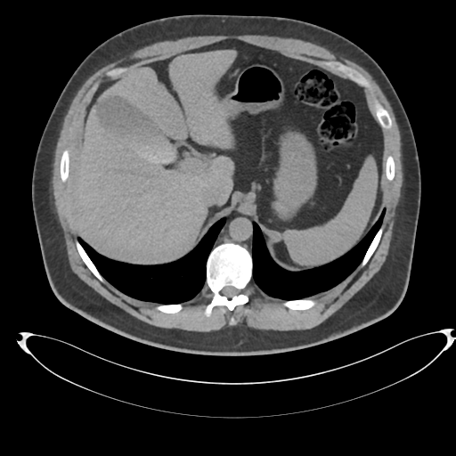 Adrenal cyst (Radiopaedia 45625-49778 Axial non-contrast 21).png
