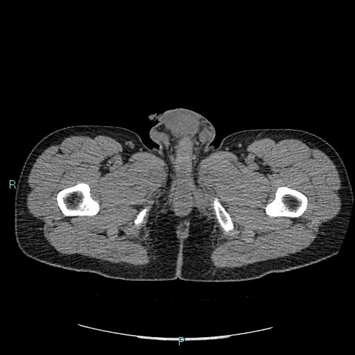Adrenal cystic lymphangioma (Radiopaedia 83161-97534 Axial non-contrast 112).jpg