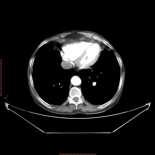 Adrenal hemangioma (Radiopaedia 68923-78668 Axial C+ arterial phase 12).jpg