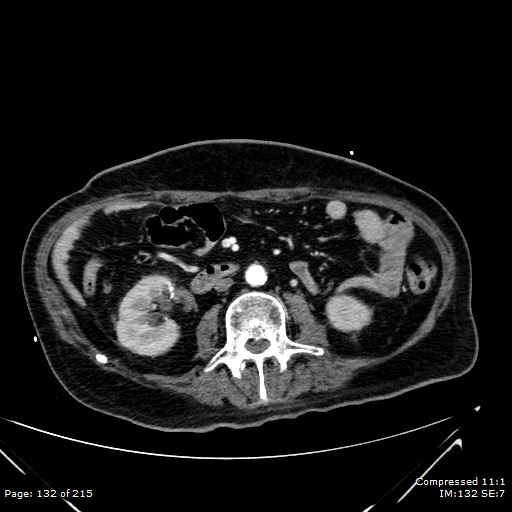 Adrenal metastasis (Radiopaedia 78425-91079 Axial C+ arterial phase 62).jpg