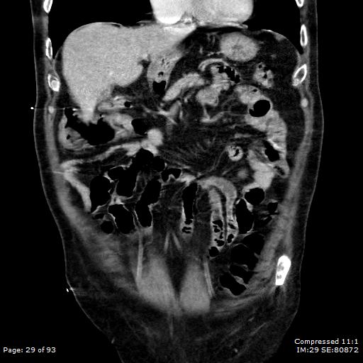 Adrenal metastasis (Radiopaedia 78425-91079 Sagittal C+ portal venous phase 16).jpg
