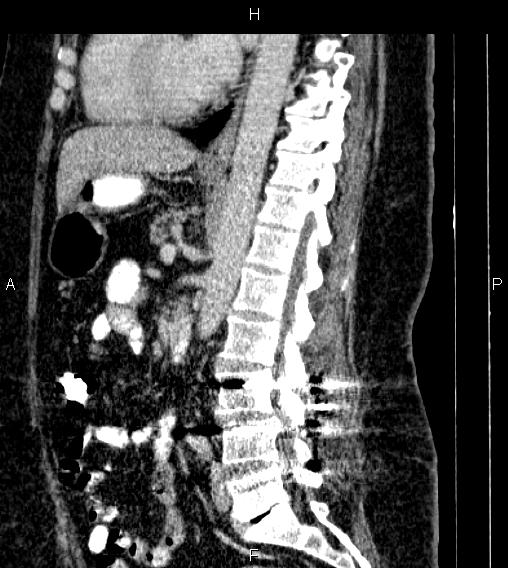 Adrenal myelolipoma (Radiopaedia 84319-99617 Sagittal renal cortical phase 52).jpg