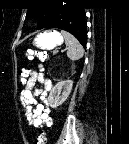 Adrenal myelolipoma (Radiopaedia 84319-99617 Sagittal renal cortical phase 74).jpg