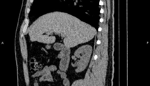 Adrenal myelolipoma (Radiopaedia 84321-99619 Sagittal non-contrast 37).jpg