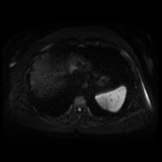 File:Adrenal myelolipoma - MRI (Radiopaedia 83249-97646 Axial DWI 2).jpg