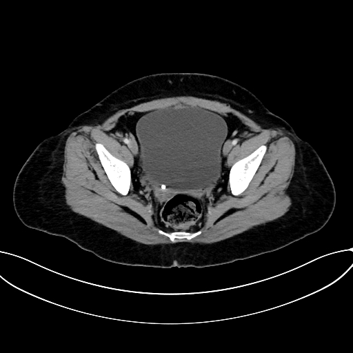 Adrenocortical carcinoma (Radiopaedia 87281-103569 Axial C+ portal venous phase 76).jpg