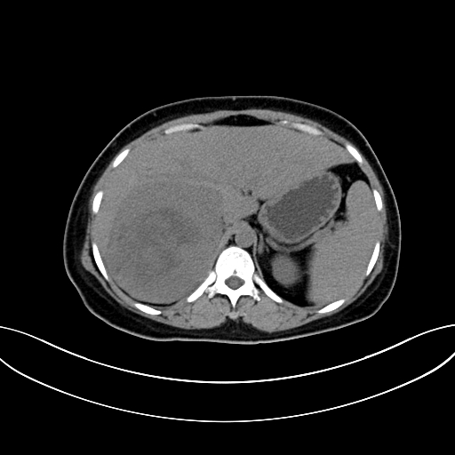 Adrenocortical carcinoma (Radiopaedia 87281-103569 Axial non-contrast 24).jpg