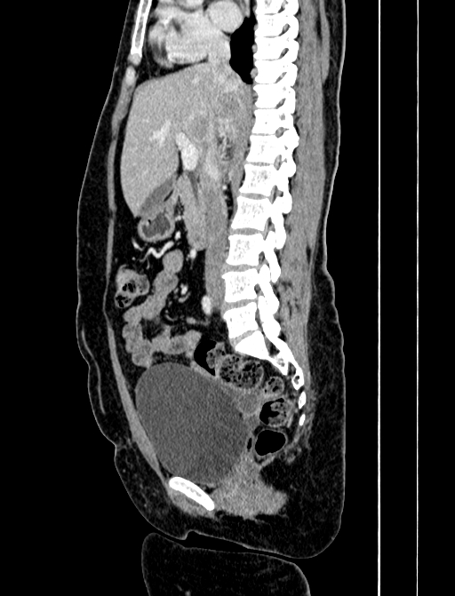 Adrenocortical carcinoma (Radiopaedia 87281-103569 Sagittal C+ portal venous phase 134).jpg