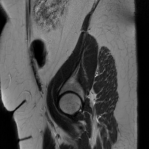 File:Adult granulosa cell tumor of the ovary (Radiopaedia 64991-73953 Sagittal T2 28).jpg