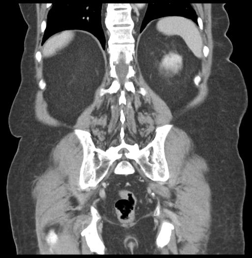 Adult ileal intussusception with secondary obstruction (Radiopaedia 30395-31051 Coronal C+ portal venous phase 48).jpg