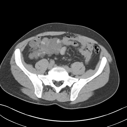 File:Adult polycystic kidney disease (Radiopaedia 47866-52626 Axial non-contrast 58).png
