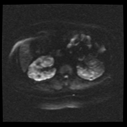 Adult polycystic kidney disease (Radiopaedia 59075-66365 Axial DWI 49).jpg