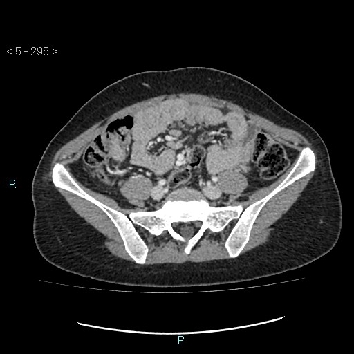 Adult transient intestinal intussusception (Radiopaedia 34853-36310 Axial C+ portal venous phase 68).jpg