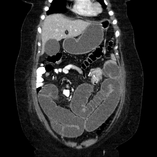 File:Afferent loop syndrome - secondary to incarcerated trocar site hernia (Radiopaedia 82959-97305 Coronal C+ portal venous phase 51).jpg