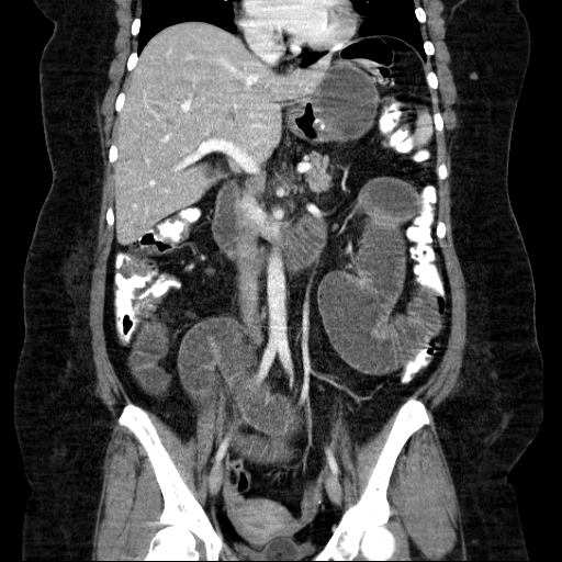 File:Afferent loop syndrome - secondary to incarcerated trocar site hernia (Radiopaedia 82959-97305 Coronal C+ portal venous phase 83).jpg