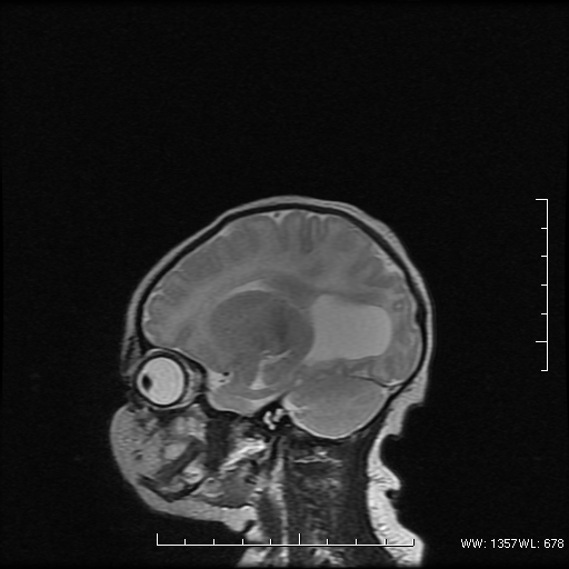 File:Agenesis of the corpus callosum (Radiopaedia 16190-16010 Sagittal T2 15).png