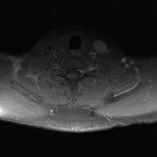 File:Aggressive vertebral hemangioma (Radiopaedia 39937-42404 Axial T1 C+ fat sat 41).png