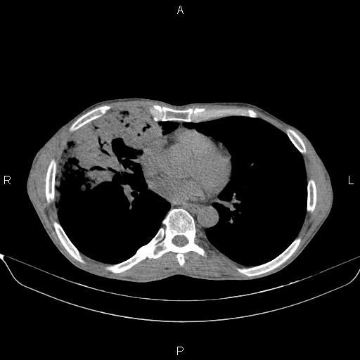 Air bronchogram in pneumonia (Radiopaedia 85719-101512 Axial non-contrast 39).jpg
