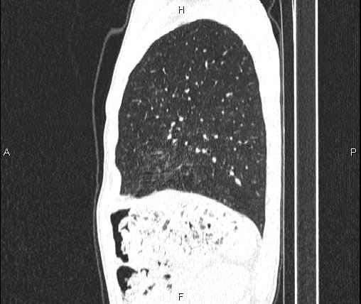Air bronchogram in pneumonia (Radiopaedia 85719-101512 Sagittal lung window 77).jpg