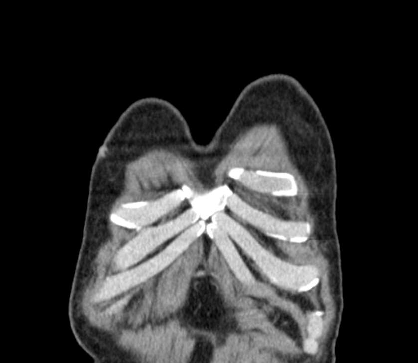 Airway foreign body in adult (Radiopaedia 85907-101779 Coronal liver window 1).jpg