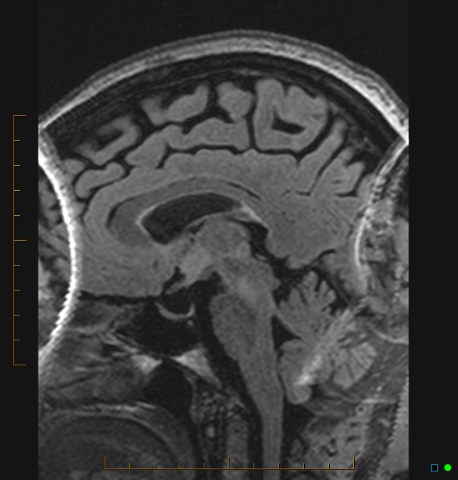 Aliasing artifact causing a spurious cerebellar lesion (Radiopaedia 48783-53810 Sagittal FLAIR 49).jpg