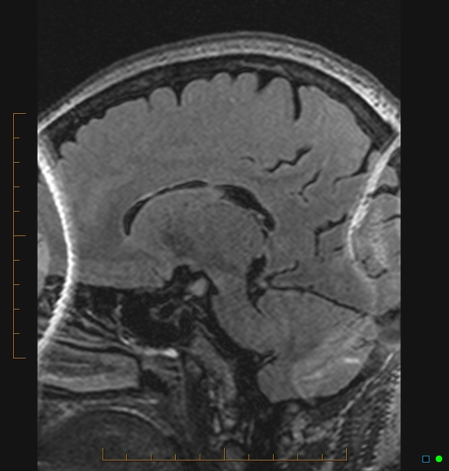 Aliasing artifact causing a spurious cerebellar lesion (Radiopaedia 48783-53810 Sagittal FLAIR 65).jpg