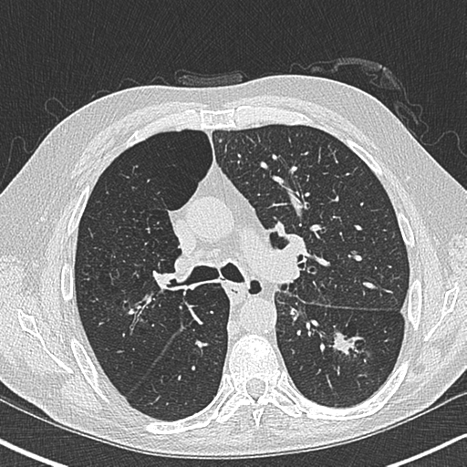 Allergic bronchopulmonary aspergillosis (Radiopaedia 44760-48571 Axial lung window 26).png