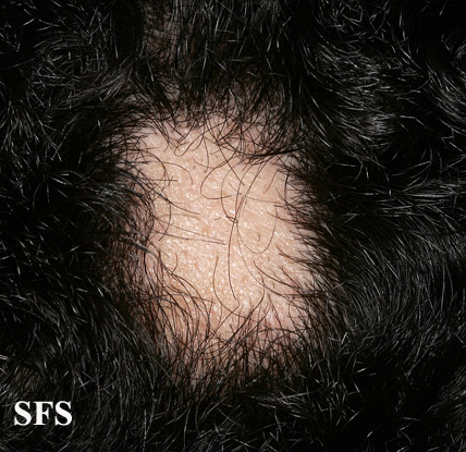 Alopecia Areata (Dermatology Atlas 57).jpg
