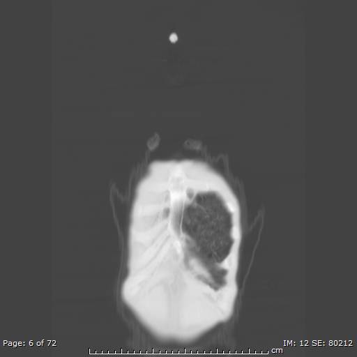 Alpha-1-antitrypsin deficiency (Radiopaedia 50561-55987 Coronal lung window 4).jpg