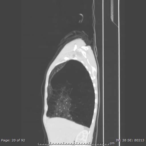 File:Alpha-1-antitrypsin deficiency (Radiopaedia 50561-55987 Sagittal lung window 10).jpg