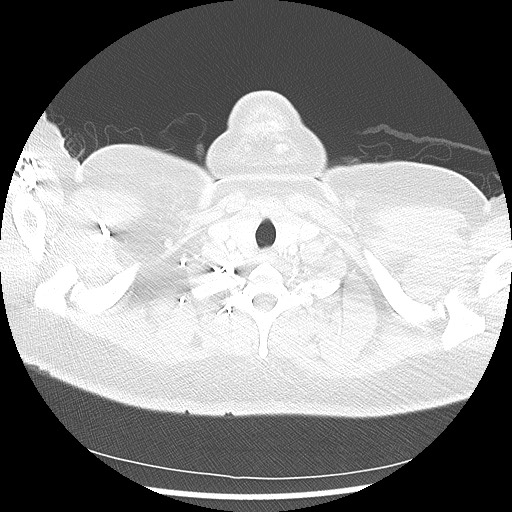Alveolar soft part sarcoma - right leg (Radiopaedia 59432-67091 Axial lung window 7).jpg