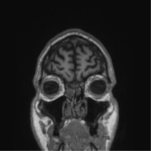 Alzheimer's disease- with Gerstmann syndrome and dressing apraxia (Radiopaedia 54882-61150 Coronal T1 82).png