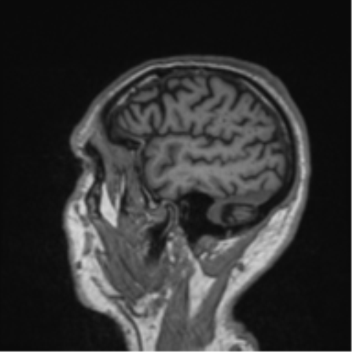 Alzheimer's disease- with Gerstmann syndrome and dressing apraxia (Radiopaedia 54882-61150 Sagittal T1 10).png