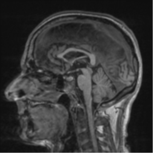 File:Alzheimer's disease- with apraxia (Radiopaedia 54763-61011 Sagittal T1 35).png