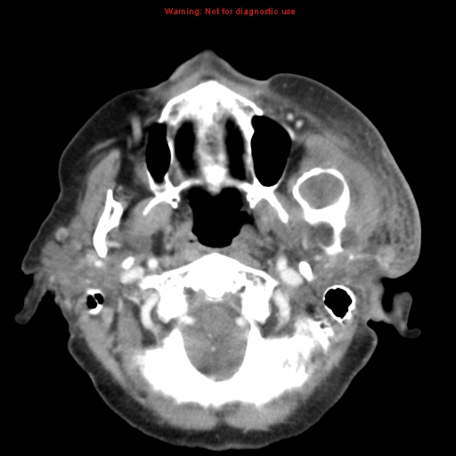 File:Ameloblastoma (Radiopaedia 27437-27631 A 23).jpg