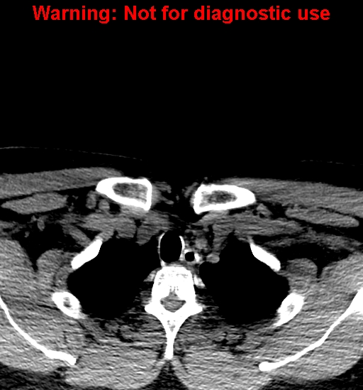 File:Ameloblastoma (Radiopaedia 33126-34164 A 47).jpg