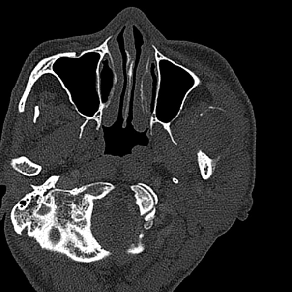 Ameloblastoma (Radiopaedia 51921-57766 Axial bone window 127).jpg