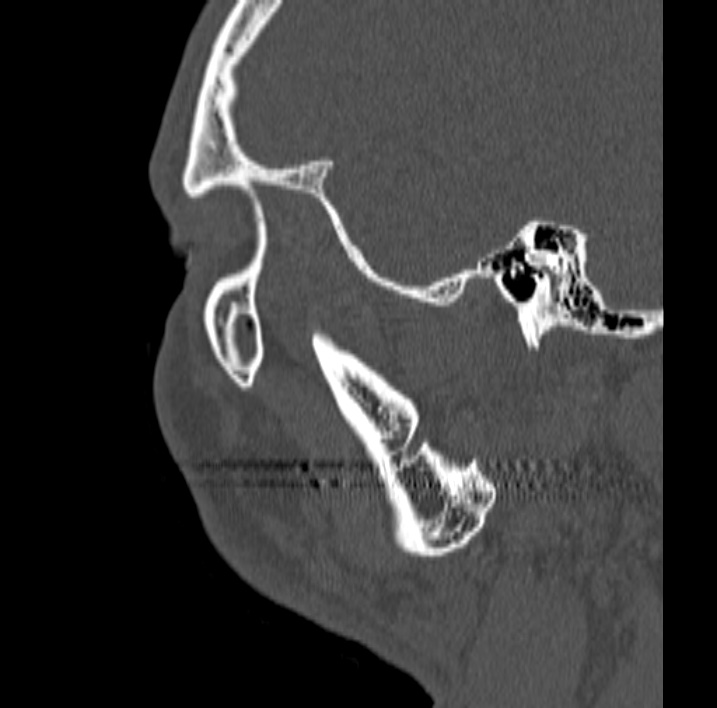Ameloblastoma (Radiopaedia 77750-89997 Sagittal bone window 97).jpg