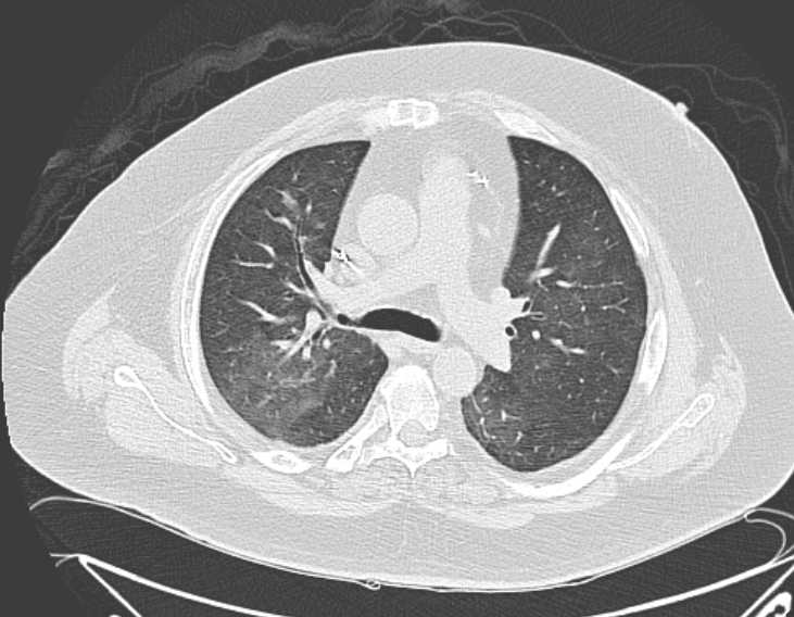 Amiodarone lung (Radiopaedia 62514-70769 Axial lung window 36).jpg