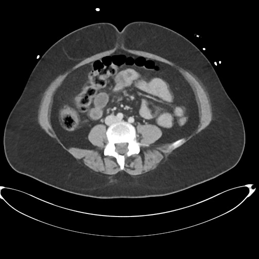 File:Amoebic liver abscess (Radiopaedia 52611-58530 A 61).png