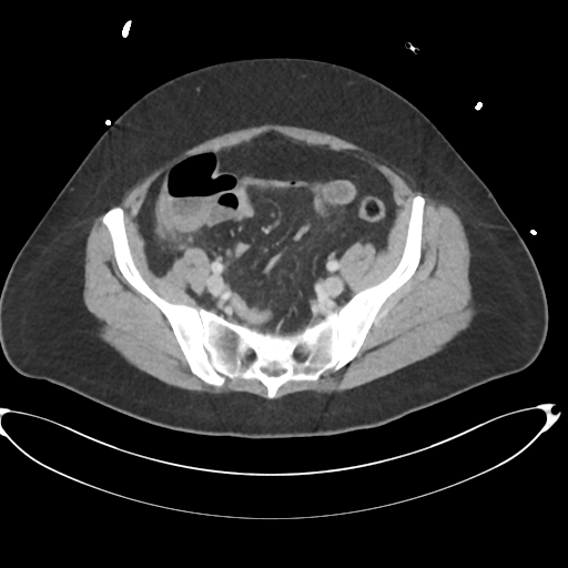 File:Amoebic liver abscess (Radiopaedia 52611-58530 A 76).png