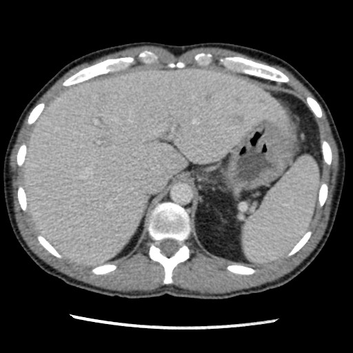 Amoebic liver abscesses (Radiopaedia 55536-62009 A 22).jpg