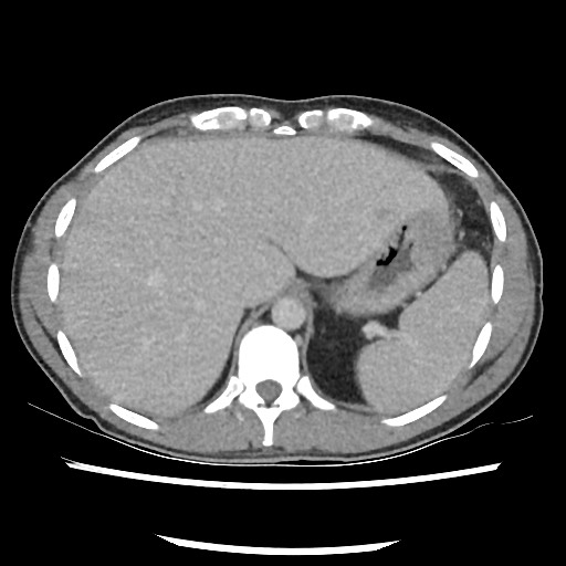 Amoebic liver abscesses (Radiopaedia 55536-62010 A 20).jpg